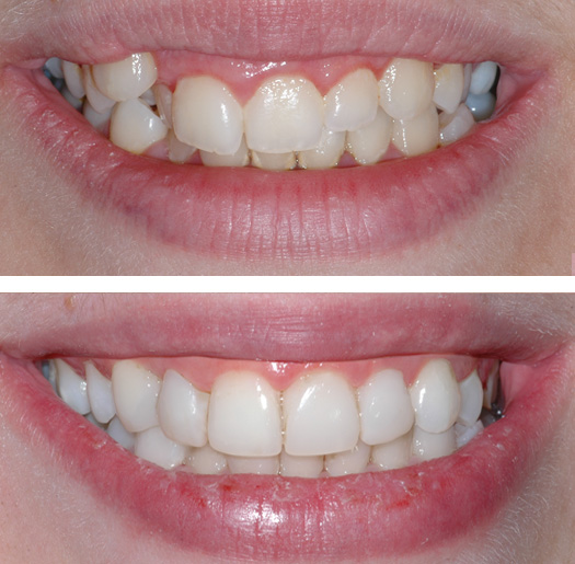 Tooth Extraction Before and After